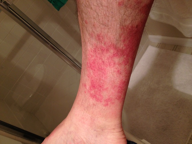 Red circular patch on leg - Dermatology - MedHelp