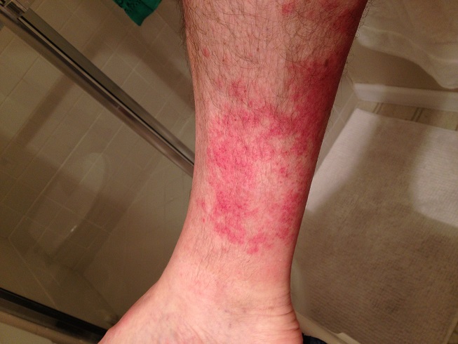 Rash on my leg - Page 2 - Unicyclist Community