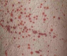 Non-Itchy Red Bumps on My Body | LIVESTRONG.COM