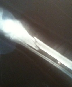 broken leg xray