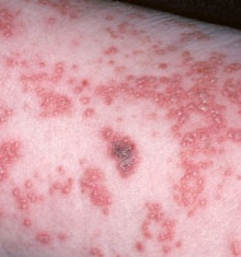 Shingles rash. Yep, looks like what I had.