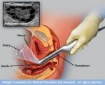 Transvaginal ultrasound, a little invasive.
