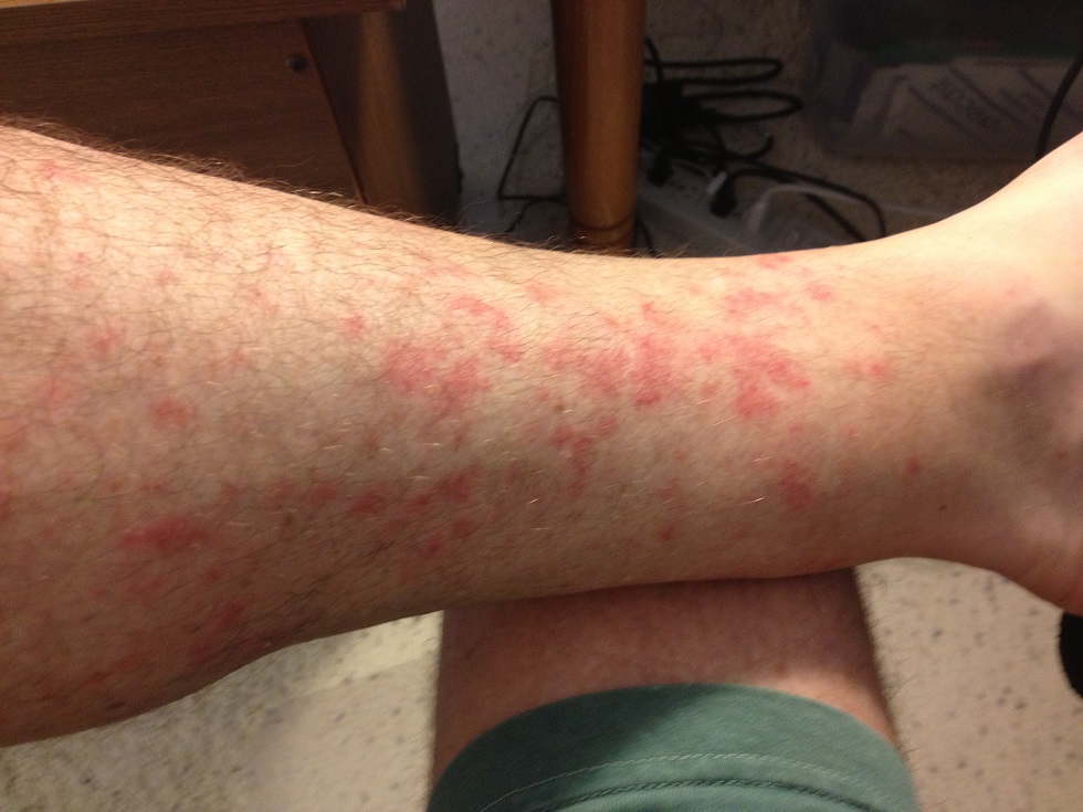 General redness develops into clusters of pin prick dots on my hiker's rash.