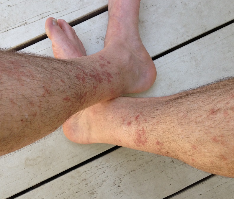 Hiker's rash: red rash between knee and ankle after hiking for