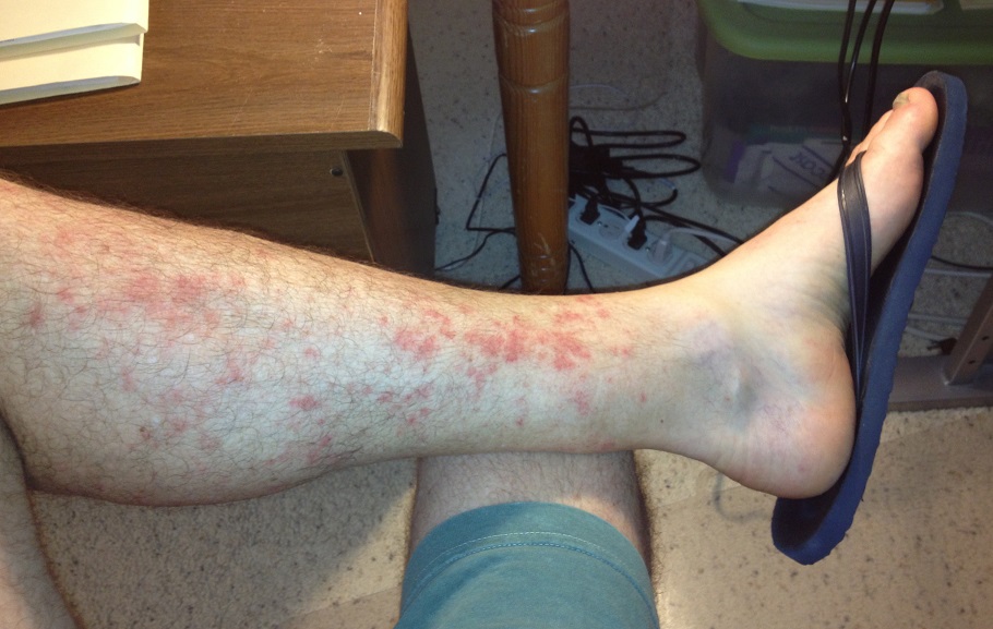Concentrated on the inside of the leg, the hiker's rash is usually between knee and ankle.
