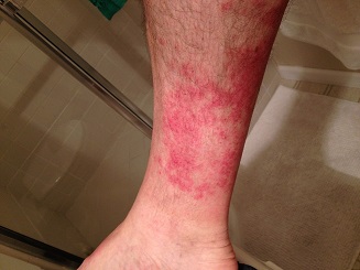 Hiker's rash from the dry weeds and stickers?